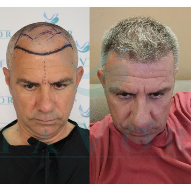 Fue hair transplant Turkey
