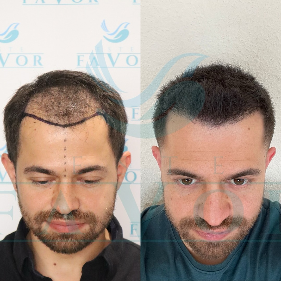 Hair Transplant India vs Turkey: Complete Comparison Guide for 2025