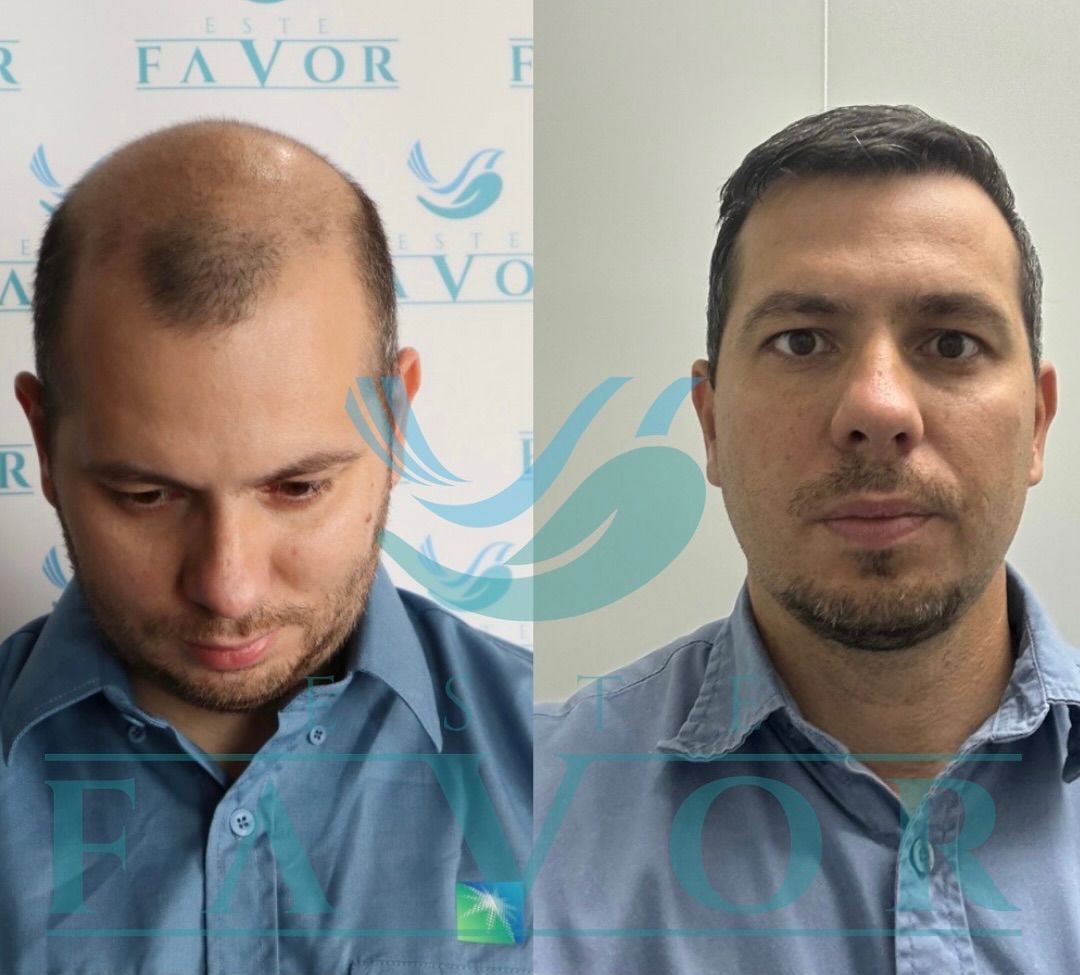 Post-OP Stärkungstherapie Haartransplantation