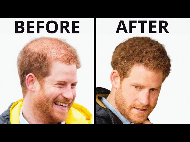 Prince Harry Hair Transplant: Analysis and Solutions