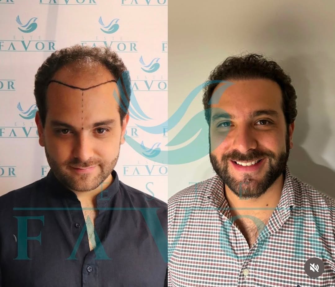 Sapphire FUE Haartransplantation in der Türkei