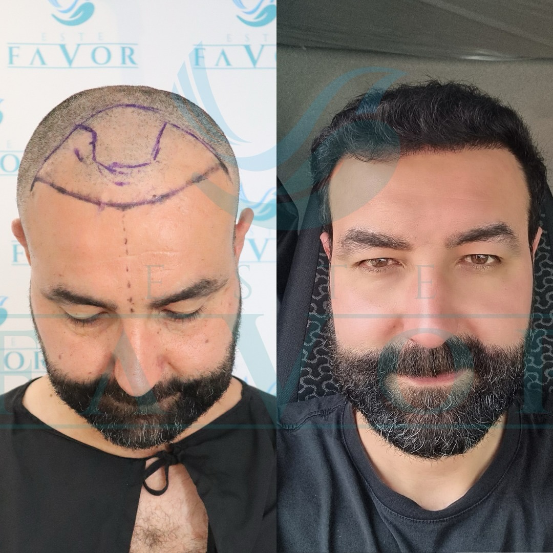 Why Do Hair Transplant Fail? Understanding Causes and How to Avoid Them