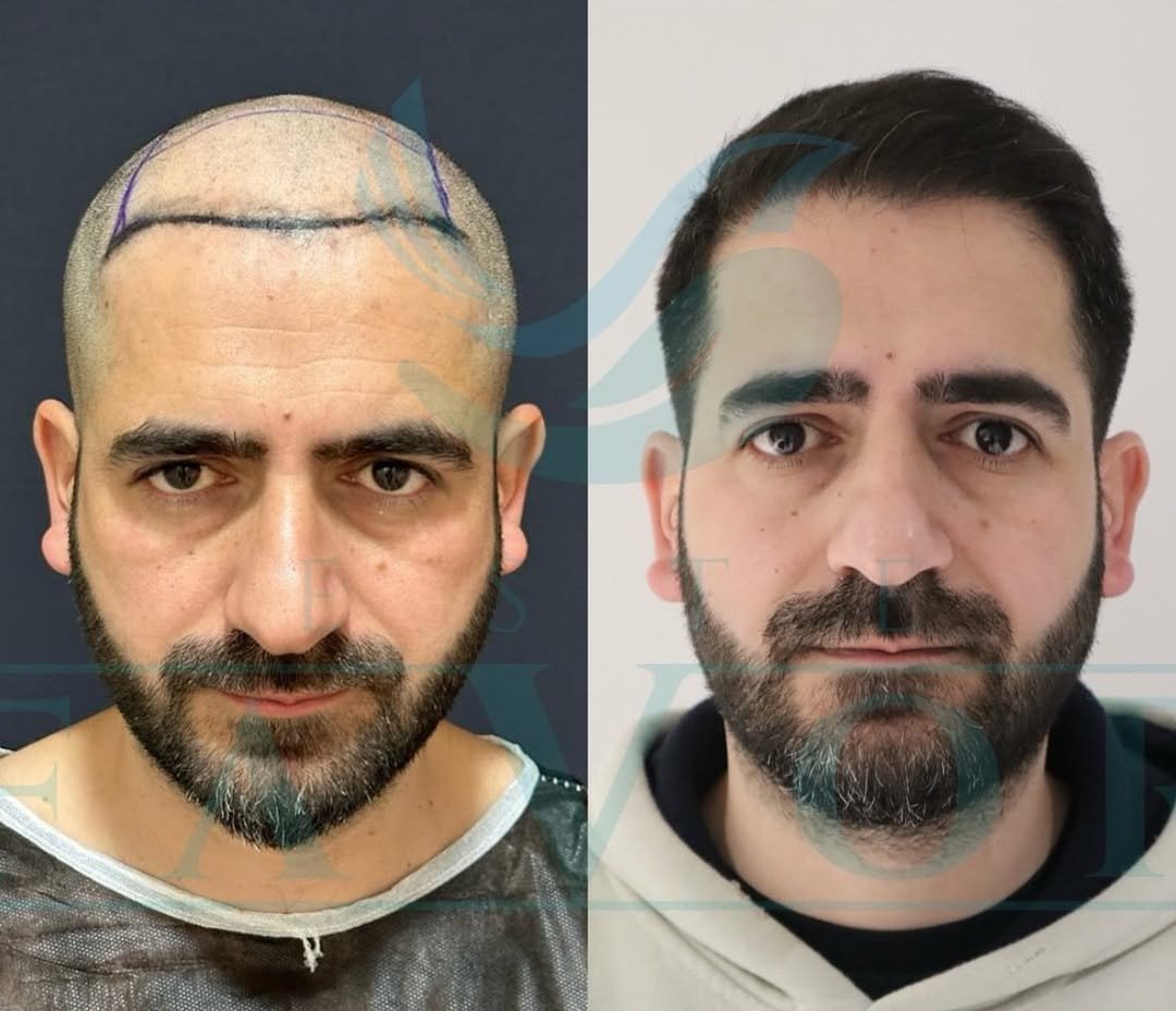 Why Is Hair Transplantation So Popular in Turkey?