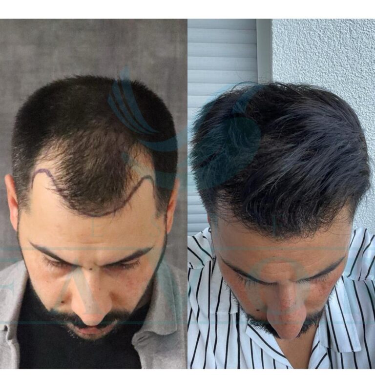 Widow's Peak Hair Transplant